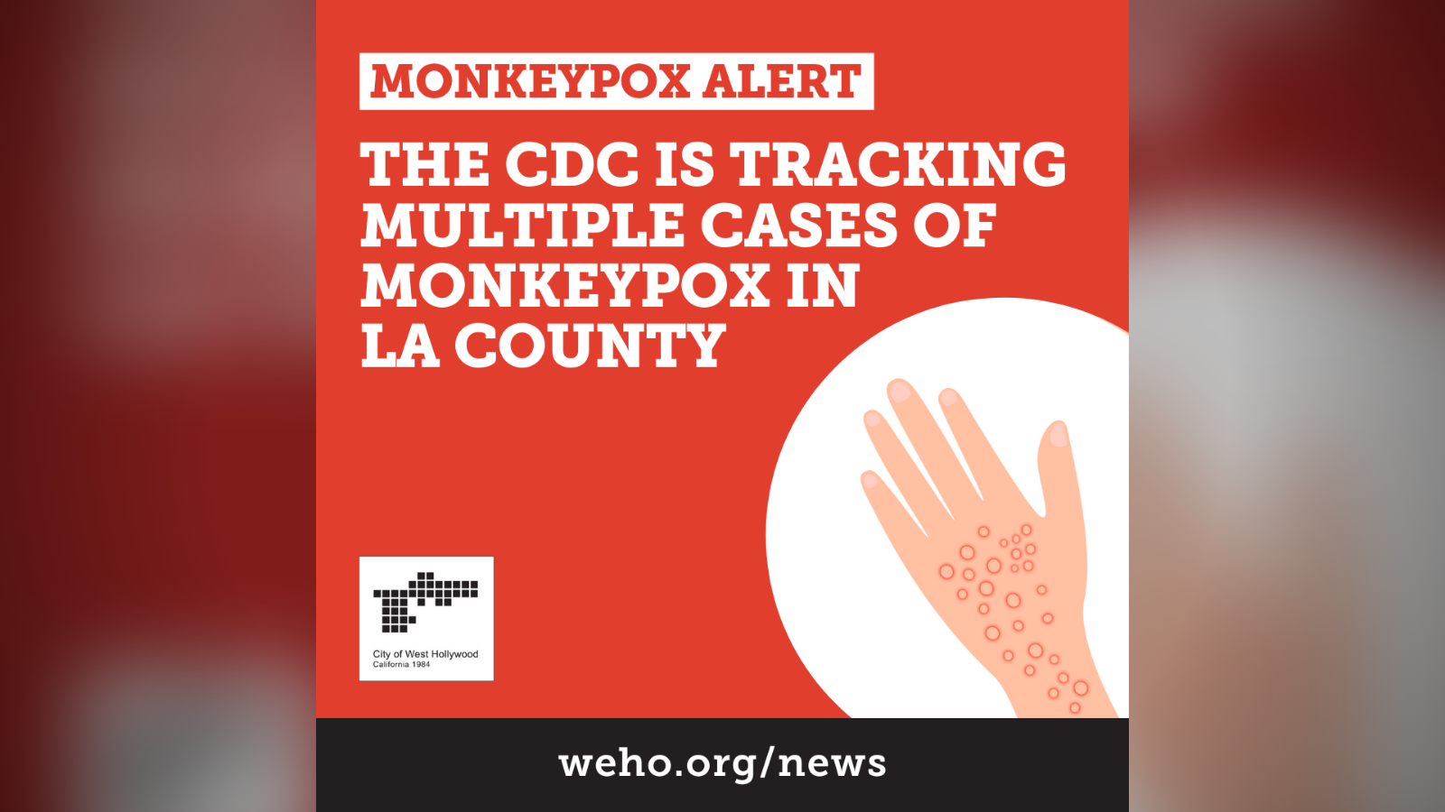 Monkeypox in LA County