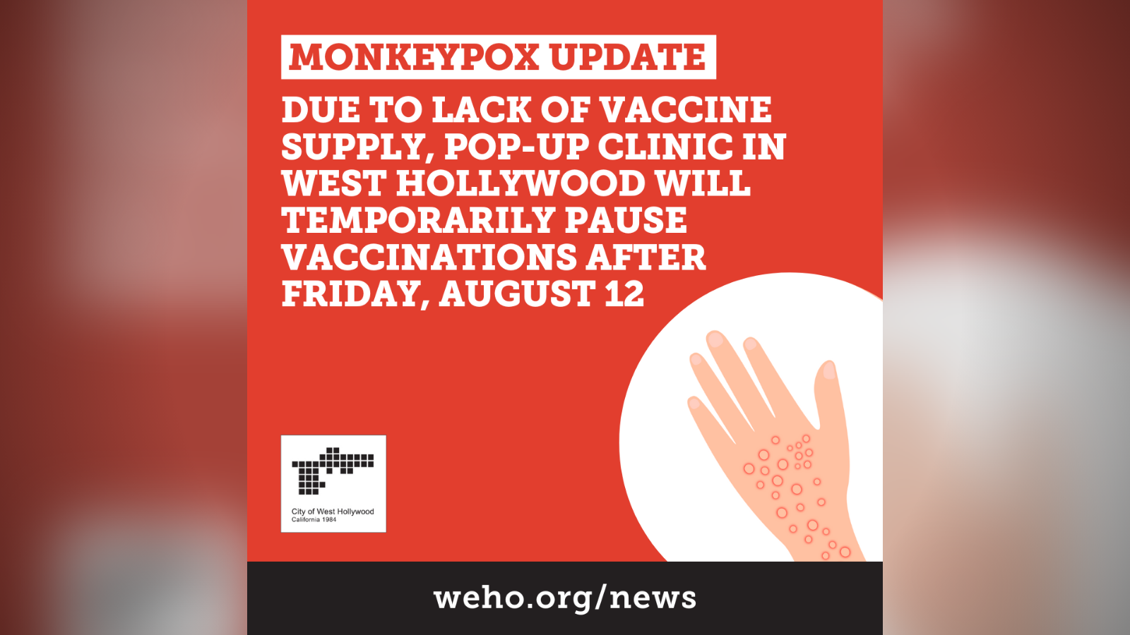 Monkeypox Update Lack of Vaccine Supply